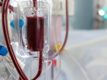 PL 8310/2017 – Isenta do Imposto de Renda as receitas provenientes da prestação de serviços de hemodiálise por hospitais e clínicas privados a pacientes do Sistema Único de Saúde (SUS).